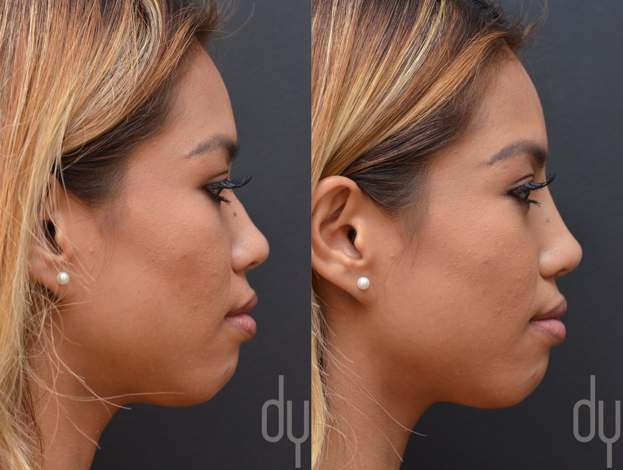 rhinoplasty surgery