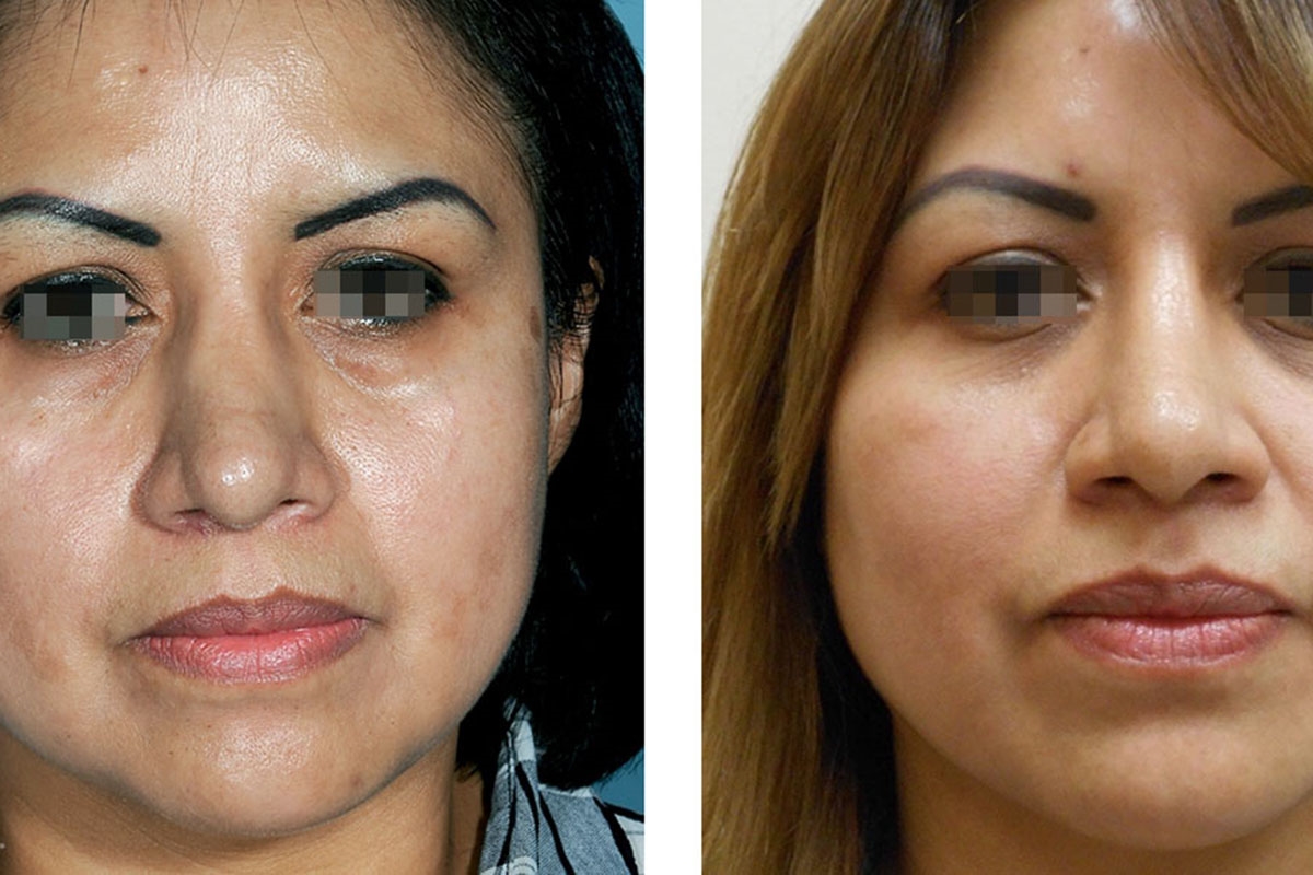 rhinoplasty surgery