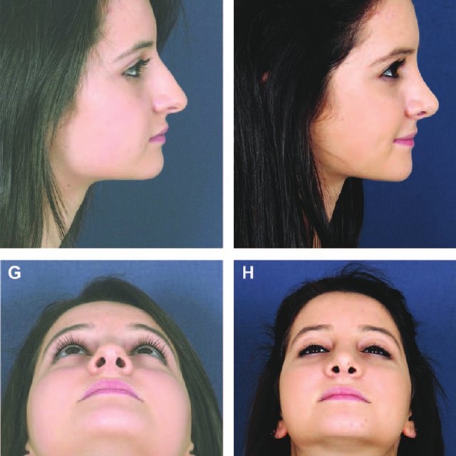 rhinoplasty surgery