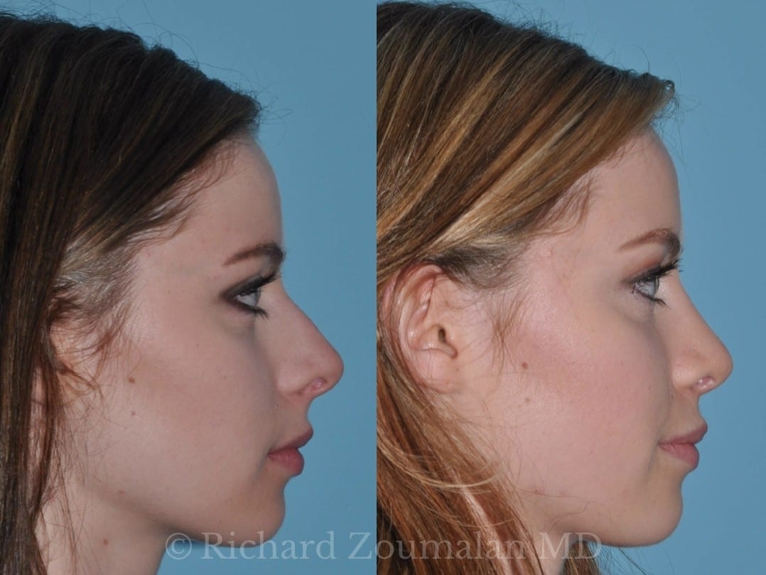 rhinoplasty surgery